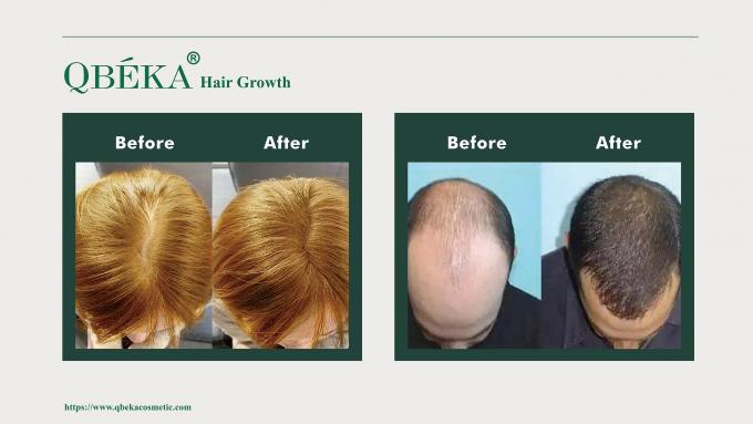 GMPC Standard 80ml Serum O Último Remédio Para Alopecia Areata Tratamento Perto de Mim 10