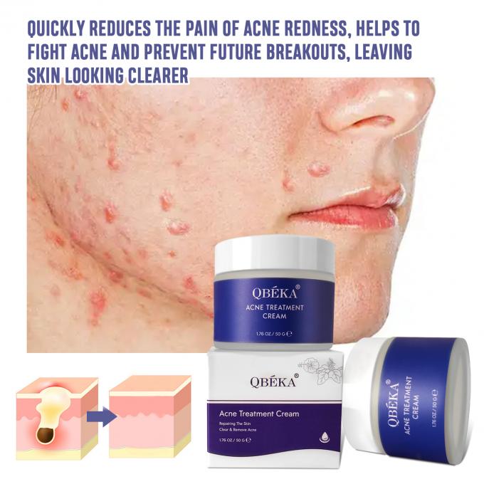 Cremas naturais e orgânicas para o tratamento da acne Quantidade 1000 5
