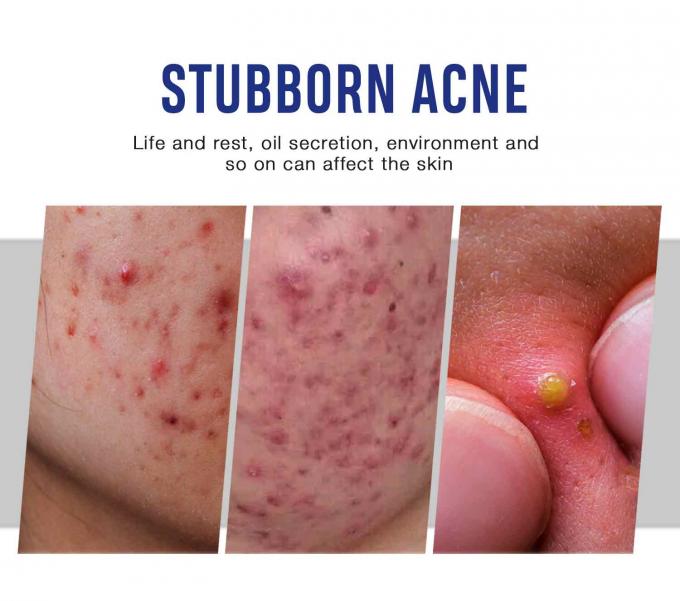 Cremas naturais e orgânicas para o tratamento da acne Quantidade 1000 7