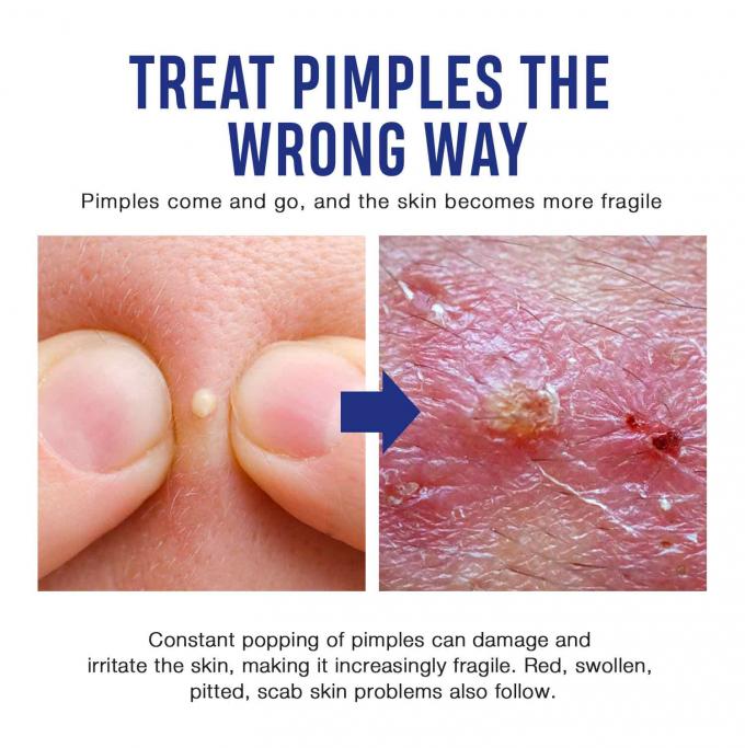 Cremas naturais e orgânicas para o tratamento da acne Quantidade 1000 8