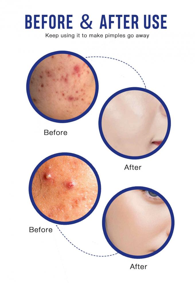 Cremas naturais e orgânicas para o tratamento da acne Quantidade 1000 9