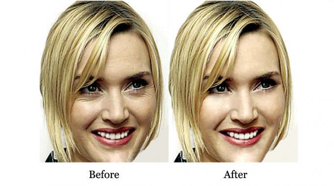 Vantagem de QBEKA Proteína Peptido Sério Retenção de Água e Reparação de Cicatrizes de Acne 10 ml 7