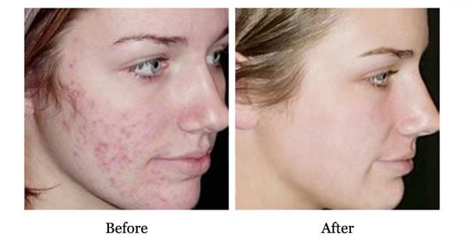 Vantagem de QBEKA Proteína Peptido Sério Retenção de Água e Reparação de Cicatrizes de Acne 10 ml 6